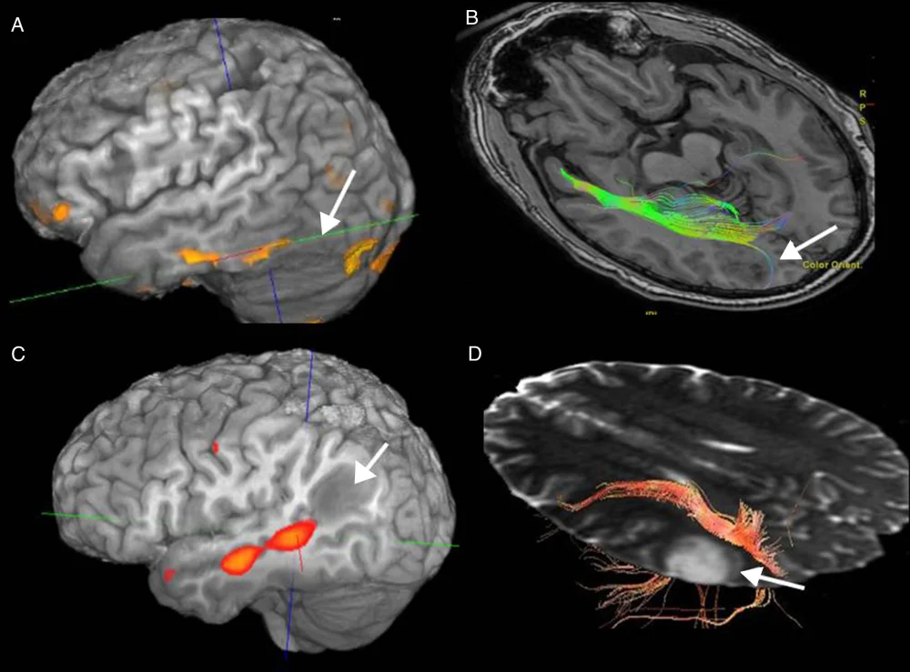 Impacto de la lesión cerebral en alexia y agrafia