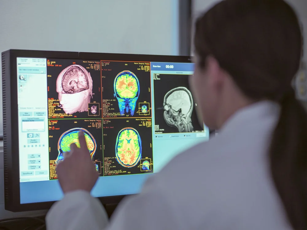 Avances Reveladores en el Tratamiento del Alzheimer