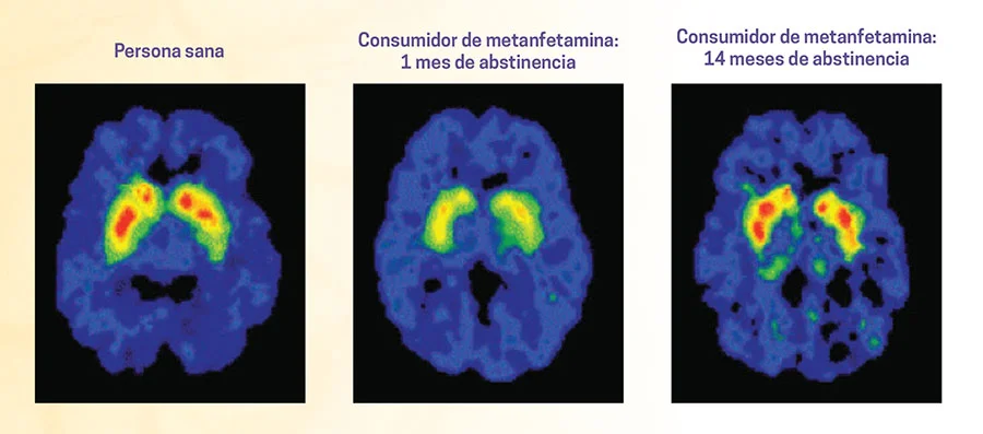 Supera la adicción a la cocaína con eficacia