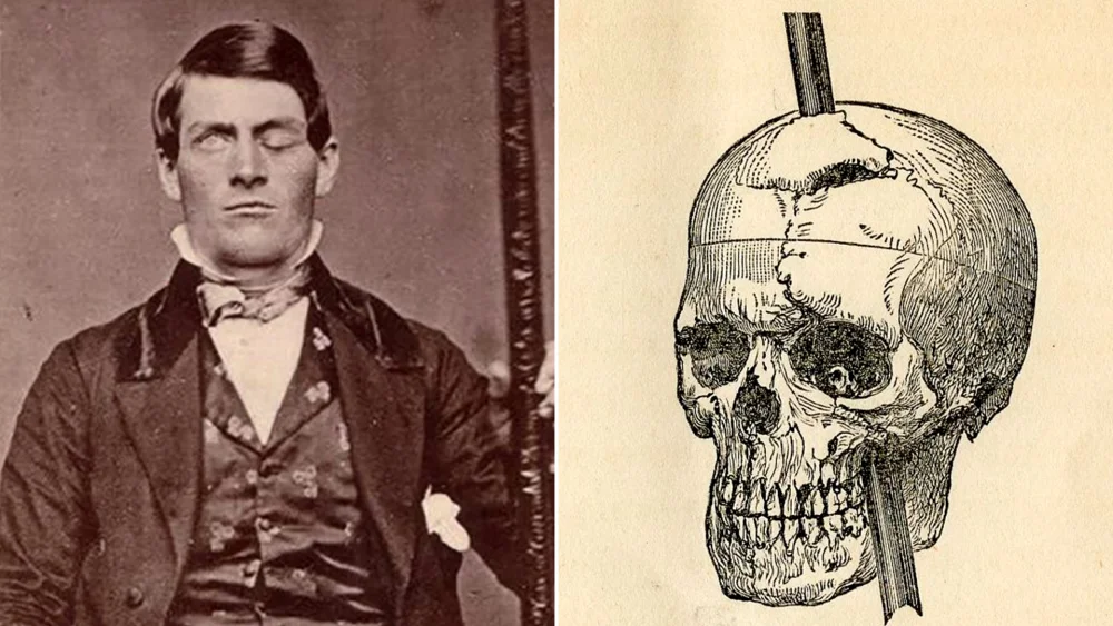 Impacto de una barra metálica en la vida de Phineas Gage
