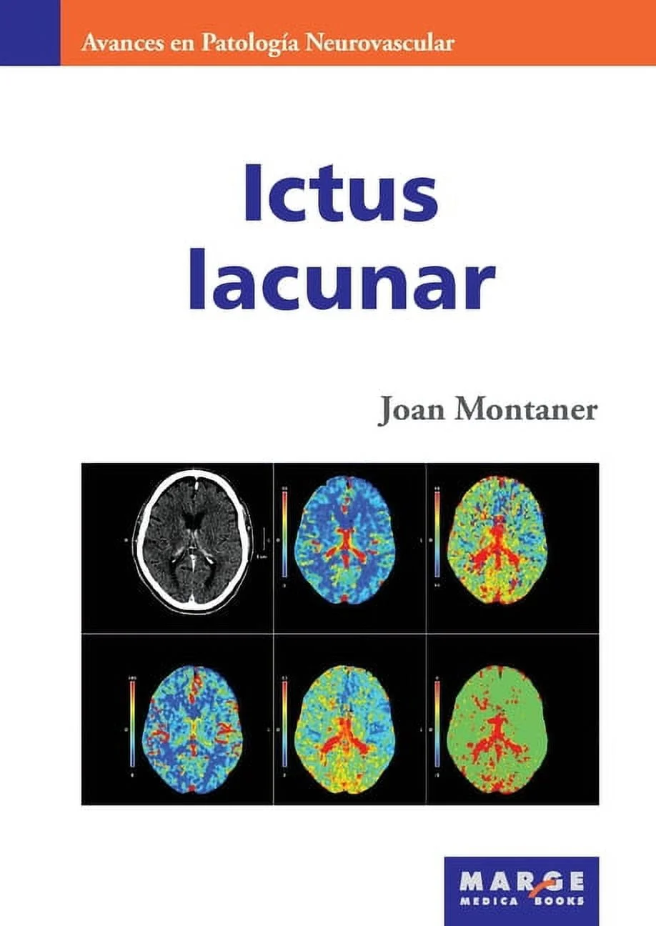 Guía Completa sobre el Infarto Lacunar