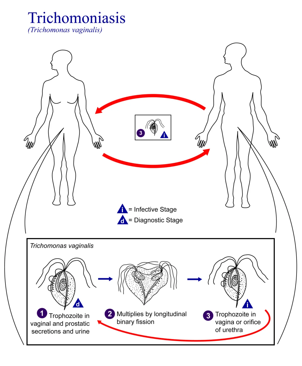 Todo lo que necesitas saber sobre la tricomoniasis