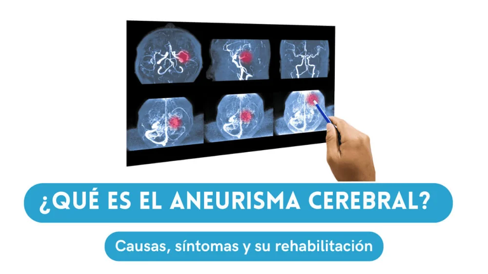 Comprendiendo el aneurisma cerebral: causas y tratamientos efectivos