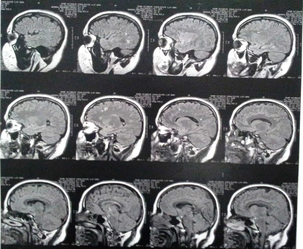 Profundiza en la microangiopatía cerebral: causas síntomas y tratamiento