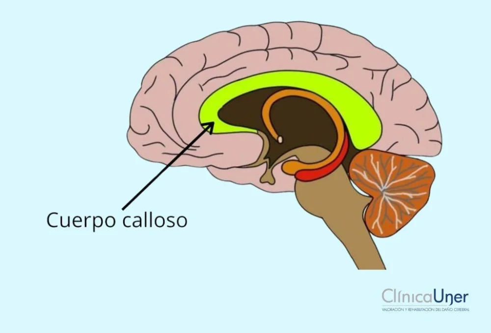 ¿Es posible vivir con parte del cerebro ausente?