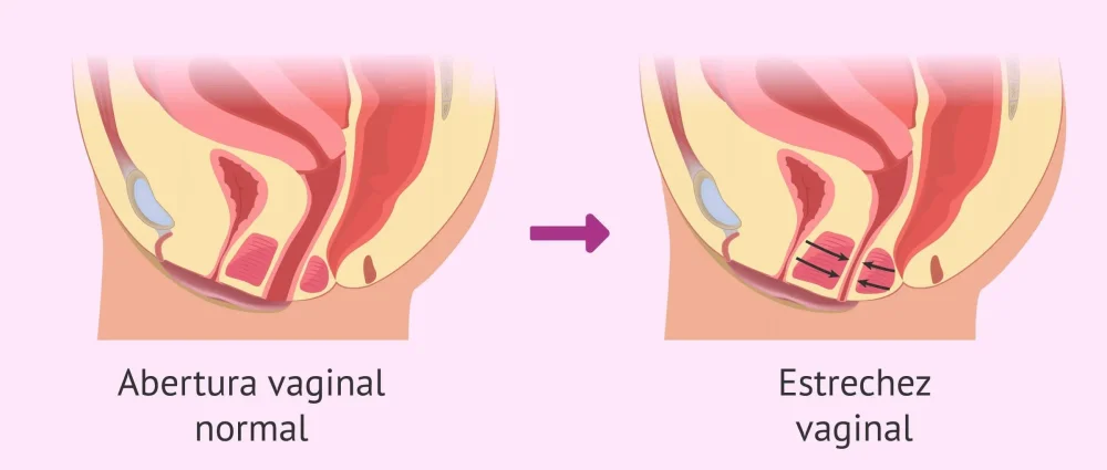Entendiendo el Vaginismo: Causas Síntomas y Soluciones