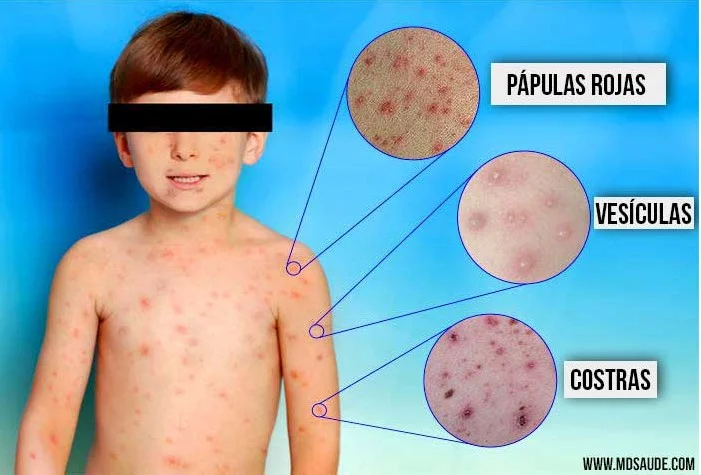 Profundiza en todos los aspectos de la mielitis transversa