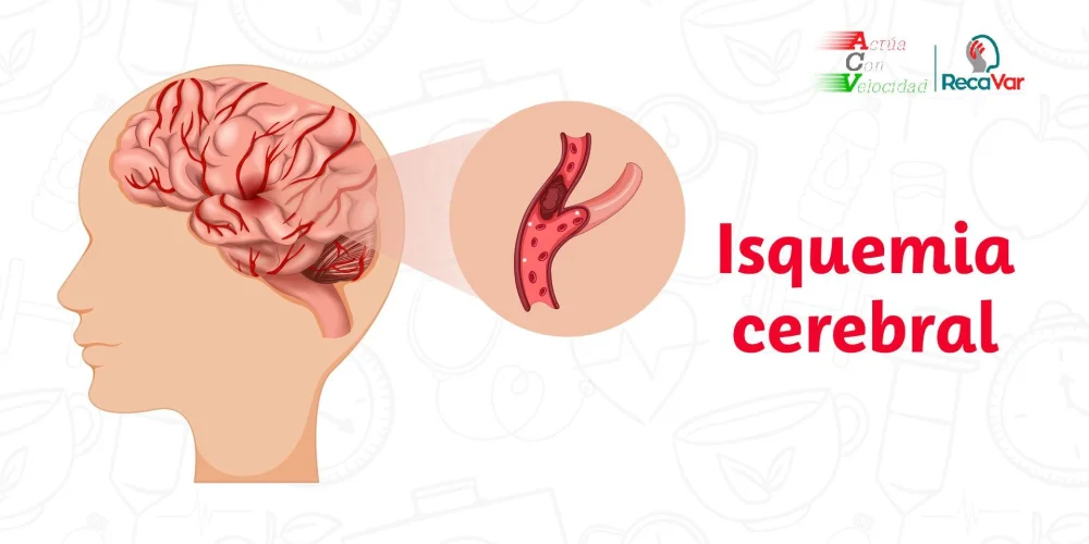 Causas y Prevención de la Isquemia Cerebral