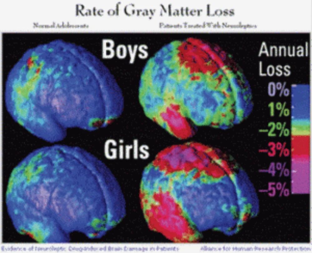 Impacto de los antipsicóticos en la salud cerebral