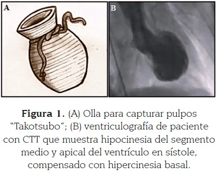 Tako-Tsubo: Todo sobre esta miocardiopatía