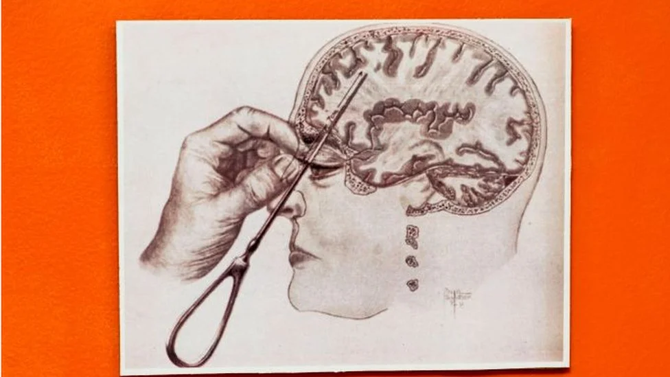 Impactos de la lobotomía en el cerebro humano