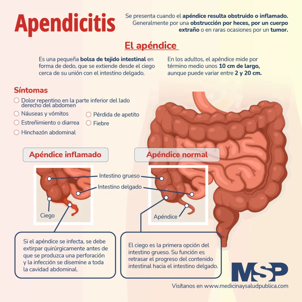 Todo sobre la apendicitis: síntomas tratamiento y prevención