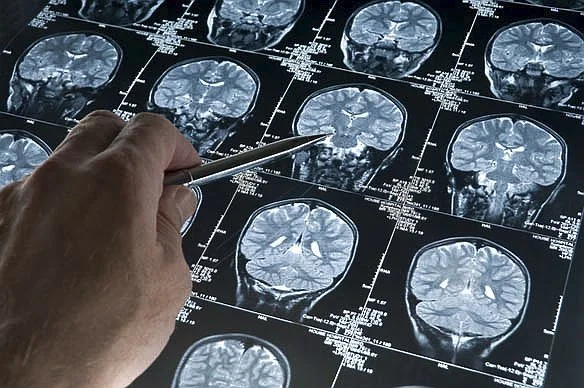 Fármaco invierte síntomas de Alzheimer en pruebas científicas
