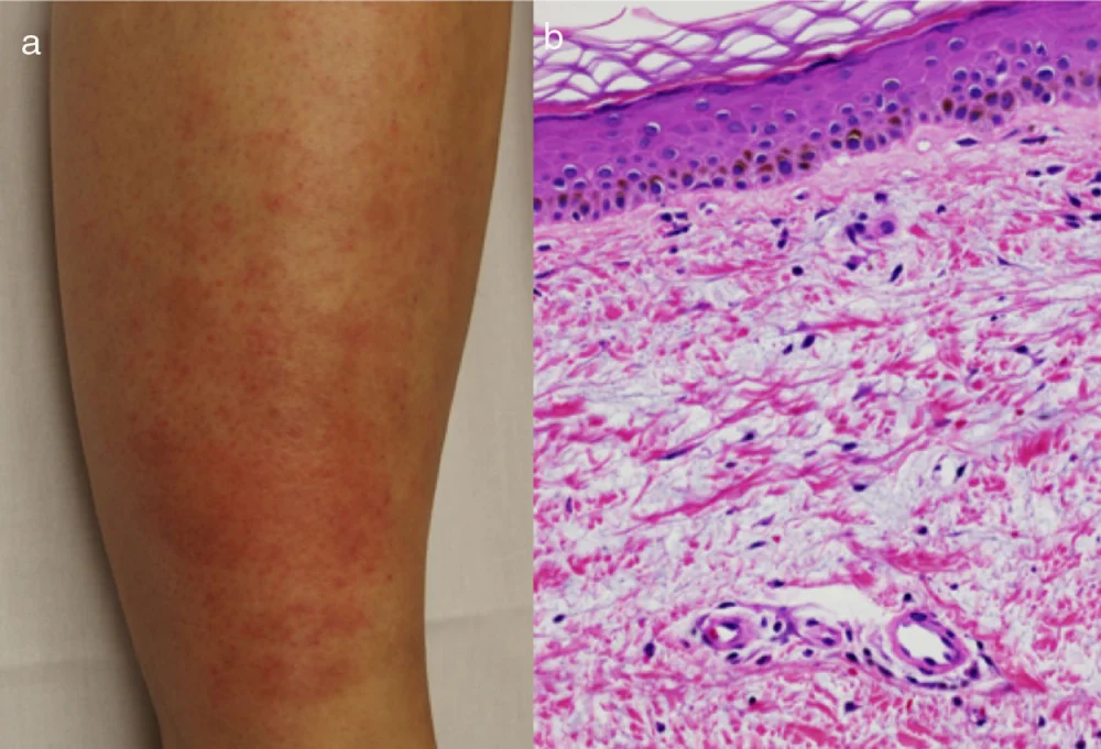 Impacto del Mixedema en la Salud y su Tratamiento