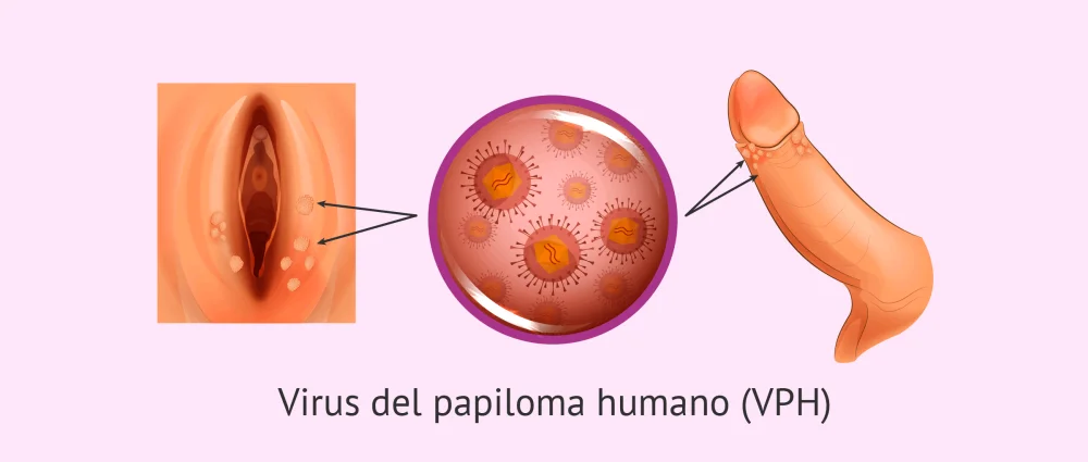 Información esencial sobre el virus del papiloma humano
