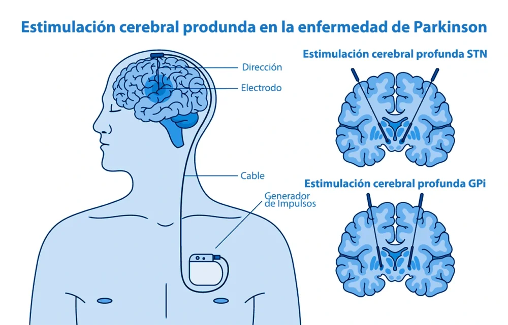 Efectos y beneficios de la levodopa en el tratamiento neurológico
