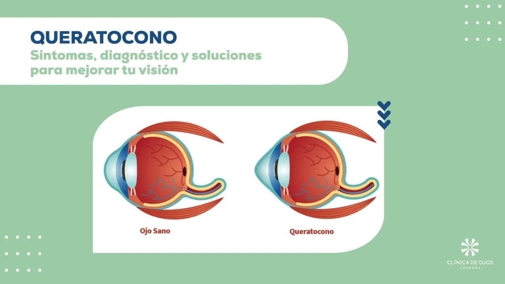 Comprende las causas y soluciones para la fotofobia