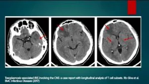 Impacto de la toxoplasmosis en la mente