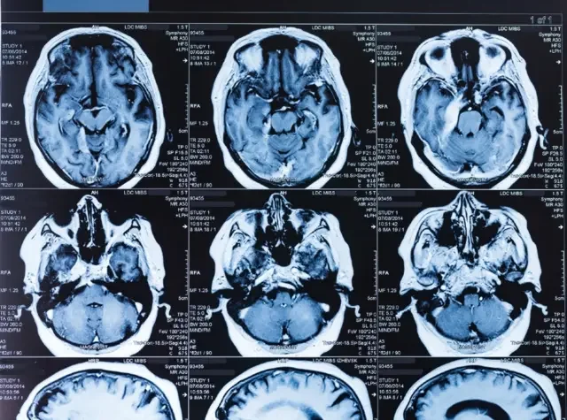 Impacto de los traumas en el cerebro humano