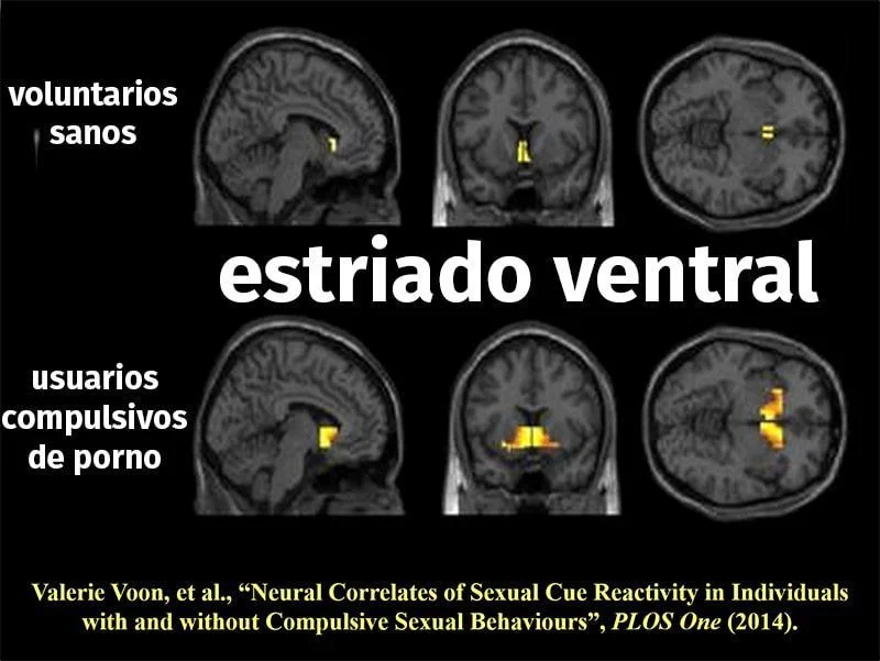 Impacto del porno en el cerebro humano
