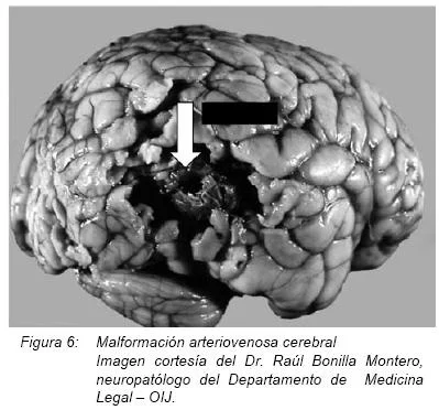 Profundiza en la atrofia cortical y sus implicaciones