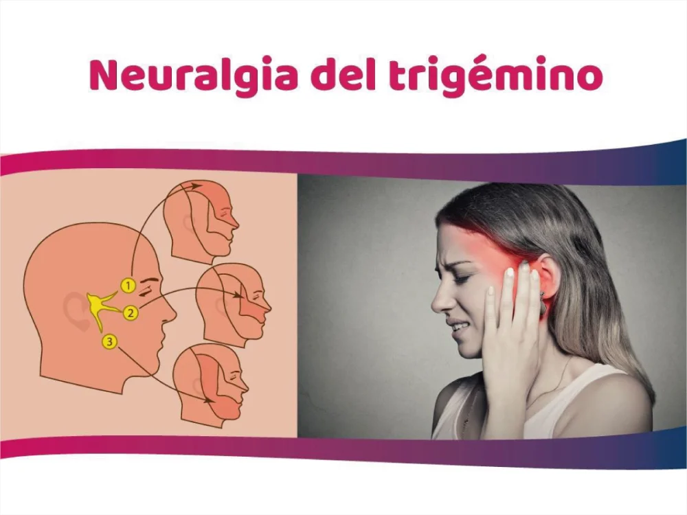 Alivio y tratamiento para la neuralgia del trigémino