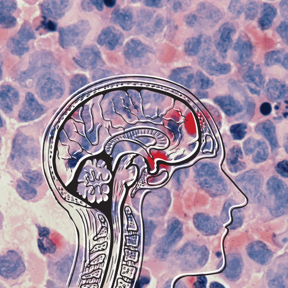 Virus del herpes vinculado a problemas neurológicos persistentes