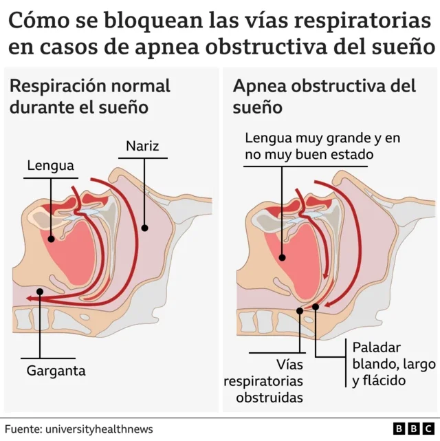 Secretos de la Enfermedad del Sueño: Impacto y Prevención
