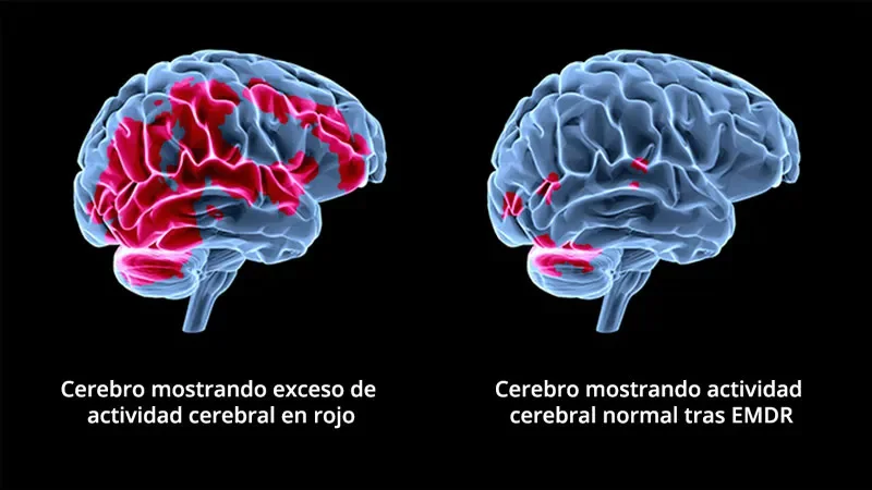 Cómo la terapia EMDR aborda el trauma eficazmente