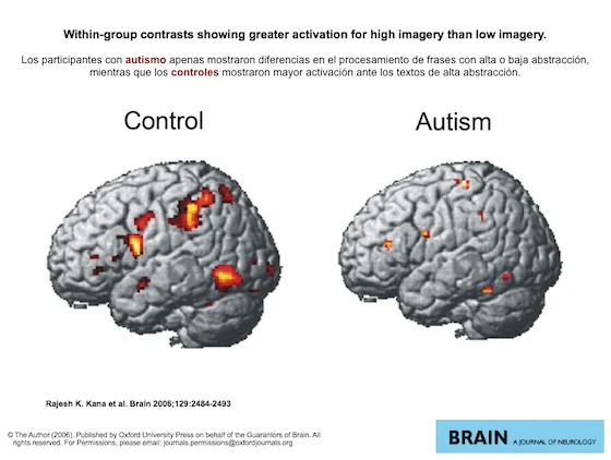 Razones de la hiperconectividad cerebral en el autismo infantil