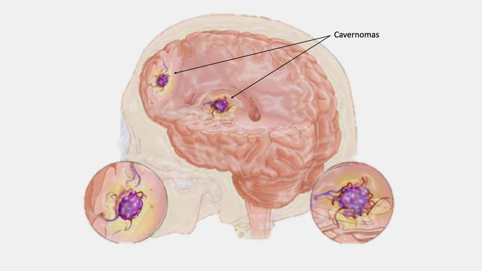Todo lo que debes saber sobre el hemangioma cerebral