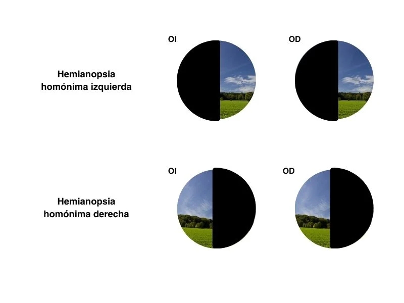 La Hemianopsia: causas diagnósticos y tratamientos esenciales