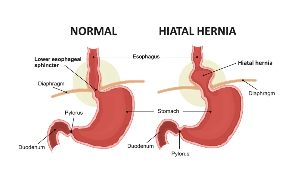 Conoce en profundidad la hernia de hiato