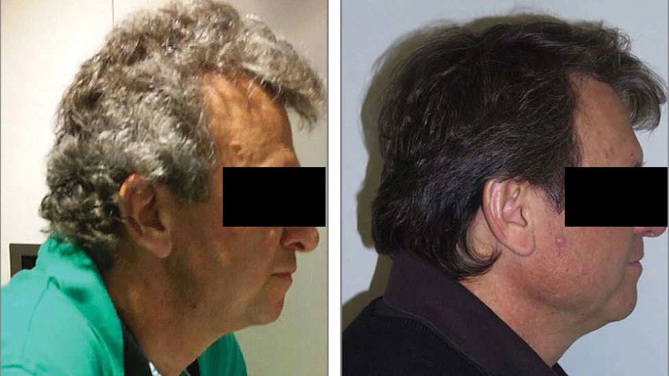Estrés: ¿Es posible que cause canas prematuras?