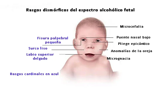 Impactos del Síndrome Alcohólico Fetal en la salud infantil