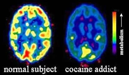 Daños cerebrales provocados por el consumo de drogas