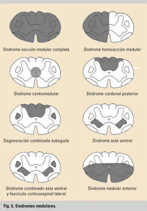 Aspectos clave del síndrome de Brown-Séquard