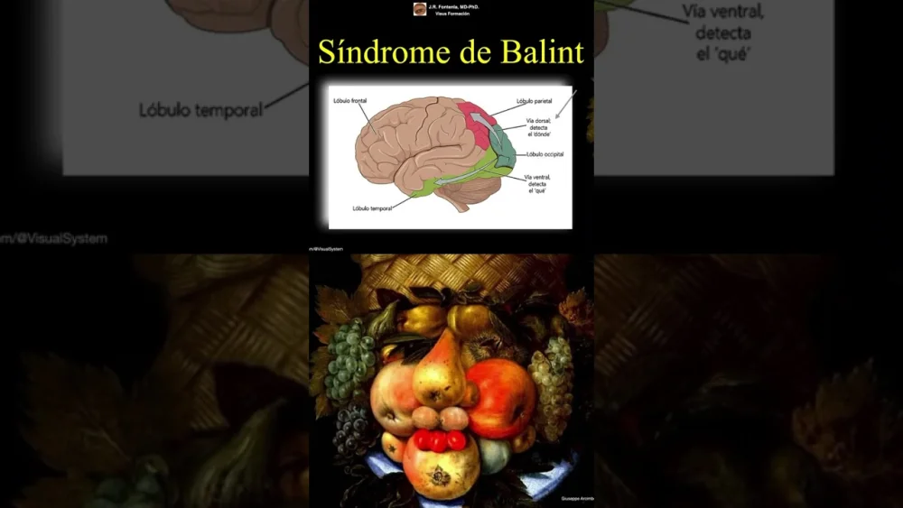 Profundiza en el Síndrome de Balint: Fundamentos y Perspectivas