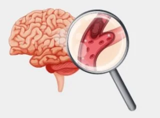 Variedades de accidente cerebrovascular: una guía esencial