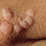 Clasificación de Verrugas: Guía Completa y Detallada