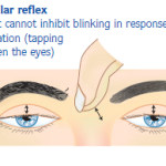 Conoce el reflejo glabelar y su importancia médica