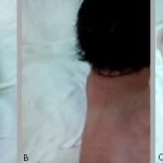 Implicaciones de la holoprosencefalia: causas y tratamiento eficaz