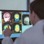 Avances Reveladores en el Tratamiento del Alzheimer
