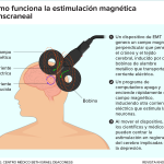 Beneficios de la Estimulación Magnética Transcraneal