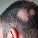 Causas y Soluciones para la Alopecia por Estrés