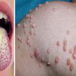 Conoce más sobre la clamidia: síntomas y prevención