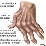 Conoce Todo sobre el Reuma