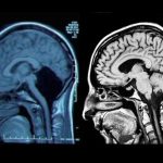 El sorprendente caso de la mujer sin cerebelo