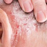 Enfermedades Dermatológicas: Información y Tratamientos Efectivos