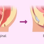 Entendiendo el Vaginismo: Causas Síntomas y Soluciones
